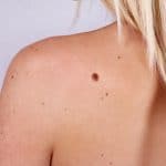 Young woman with at birthmark on her back, skin.