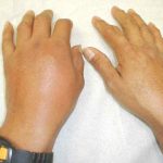 Aussi-bien-les-pieds-que-les-mains-la-goutte-touche-toutes-les-articulations