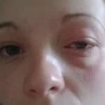 Conjonctivite_Virale