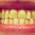 Deviated_midline_2