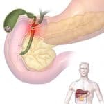 Gallstones_and_Ascending_Cholangitis