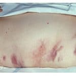 Hemorrhagic_pancreatitis_-_Grey_Turner&rsquo;s_sign