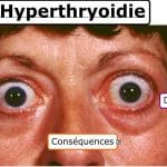 Hyperthyroïdie