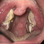 Mononucleosis1