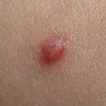 Papilloma_2009_G2