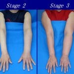 Upper_limb_lymphedema