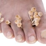 mycosis