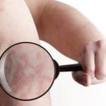 urticaria