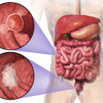 640px-Blausen_0246_ColorectalCancer