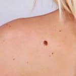 7178859_grains-de-beaute-cancer-peau_1000x625