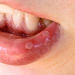 Aphthous_ulcers_on_lip