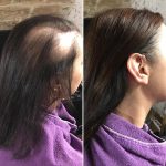 Avant-apres-pour-cacher-une-perte-de-cheveux