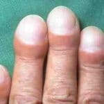 Clubbing_of_fingers_in_IPF
