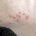 Cutaneous_findings_in_systemic_sarcoidosis