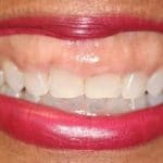 Gummy_Smile