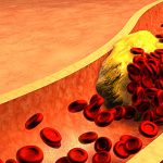 Header_Exces_Mauvais_Cholesterol jpg
