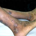 Impetigo_crouteux_jambes