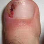 Ingrown_nail_001