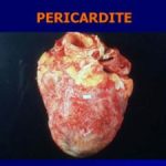Pericardite-300×225