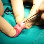 Phimosis_treatment_03