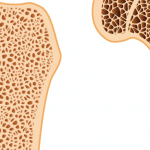 RM_osteoporosis-763×362