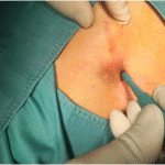 Trephine_surgery_1