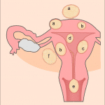Uterine_fibroids