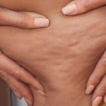 cellulite