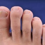 champignons-ongles