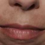melasma-upper-lip