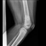 osteosarcoma-8-1