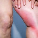 thrombose-veineuse-phlebite