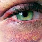 traumatismos-oculares-3-750×451