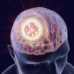 Destruction of brain tumor