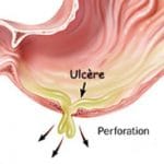 ulcere_perforation